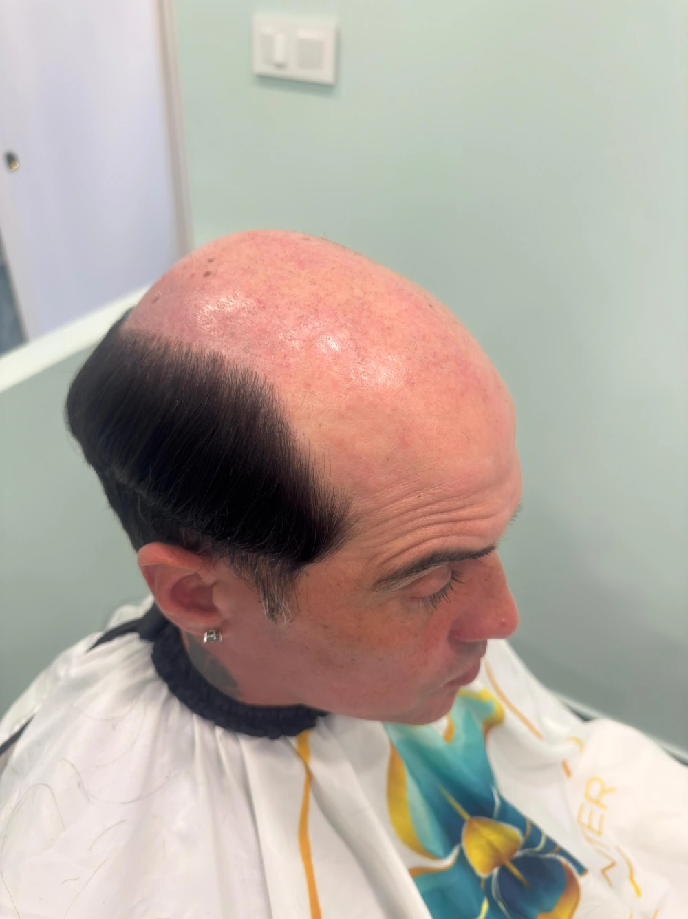 Vista del cabello antes de colocar la prótesis capilar